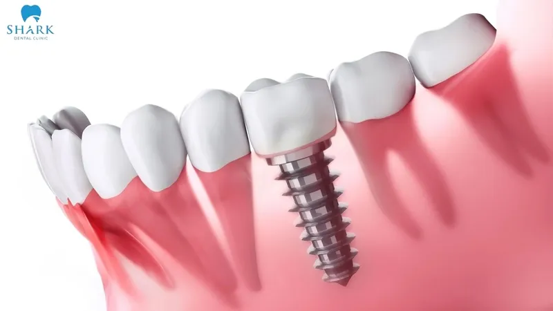 The Paltop Dynamic implant post is highly rated for its combination of premium materials and optimized design, helping deliver outstanding, stable, and long-term restoration results