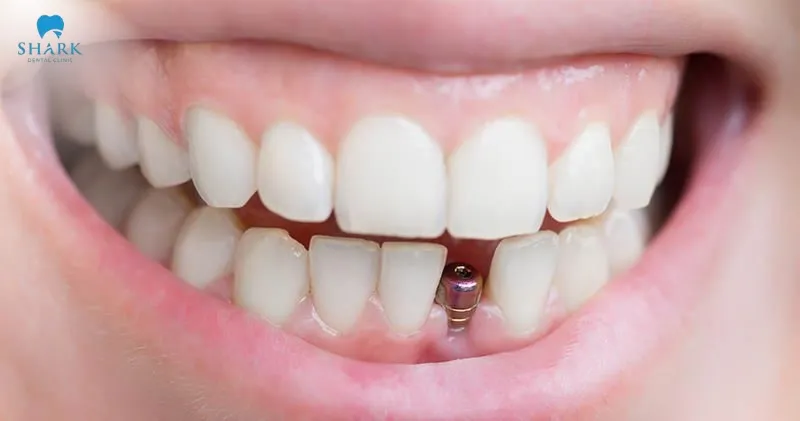 Thanks to its advanced design and modern surface treatment, the implant post helps accelerate the bonding process between the implant and the jawbone