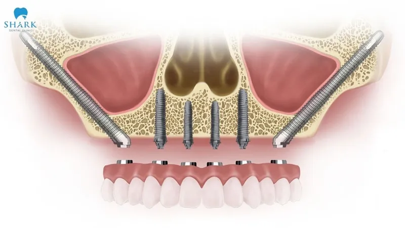 In cases of severe upper jawbone loss, the Zygomatic implant is considered an optimal solution that helps patients avoid undergoing complex bone grafting procedures