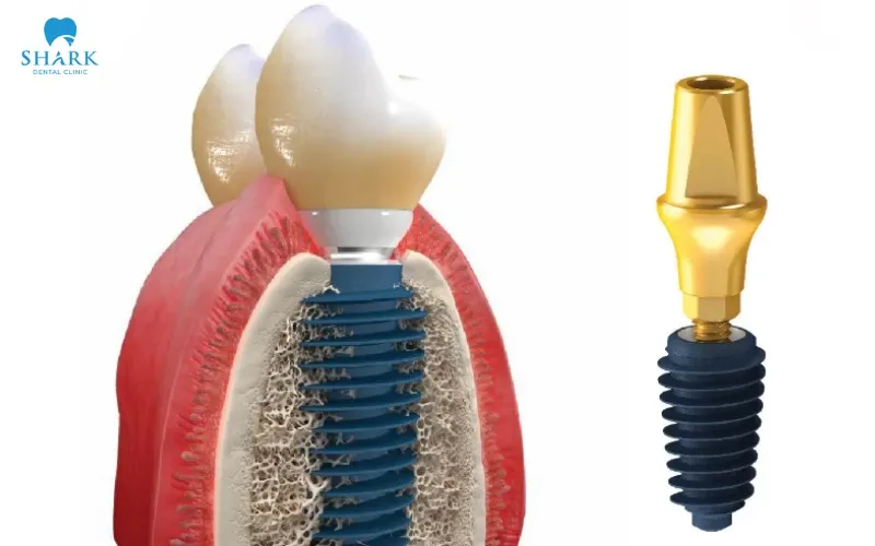 This implant line is designed with a tapered core combined with spiral threads, helping increase initial stability when placed into the jawbone