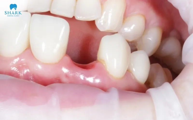 It is suitable for individuals who have lost a single tooth and still have good jawbone quality to support implant placement effectively