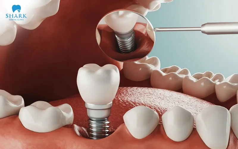 The cost of Megagen dental implant treatment usually varies flexibly depending on many different factors related to the case and restoration plan