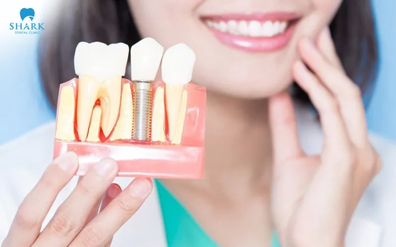 Whether this implant system is suitable or not depends largely on each person’s oral health condition, jawbone quality, and overall treatment needs