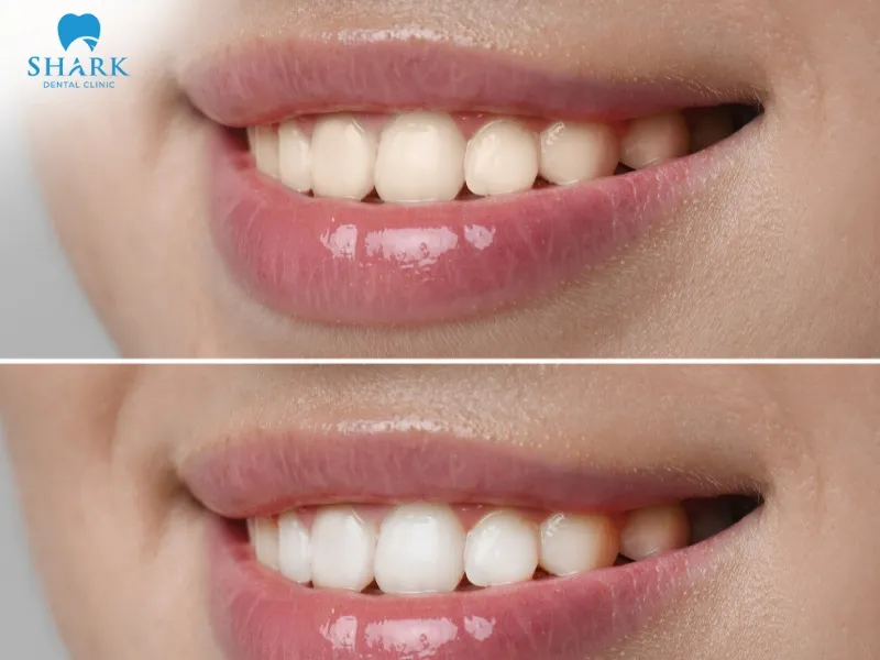 Individuals with discolored or yellowed teeth may consider porcelain veneers as a solution to improve the overall appearance of their smile