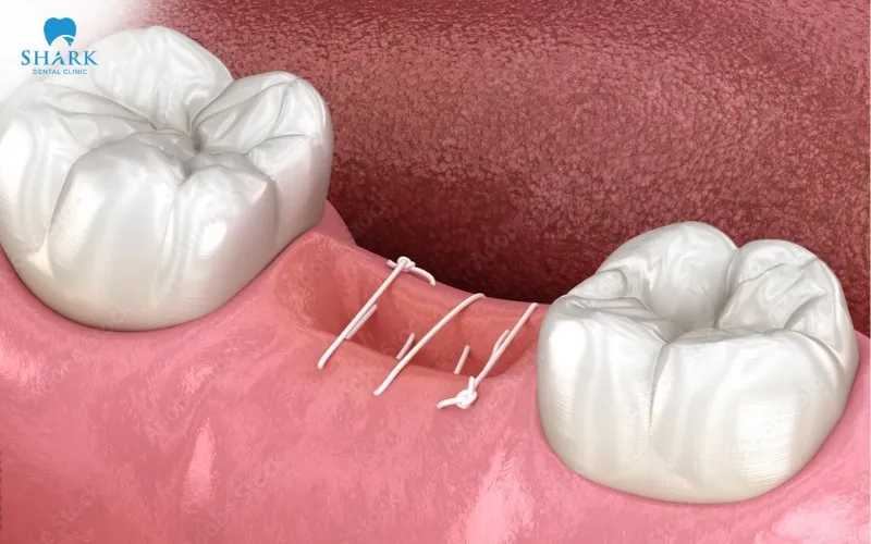 Dissolvable stitches gradually break down inside the body over time, so they usually do not require a separate removal procedure