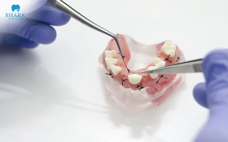 Non-dissolvable stitches offer good durability and help keep the wound stable throughout the tissue healing period until removal is recommended