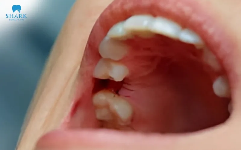 The time it takes for dissolvable stitches to disappear after tooth extraction can vary from person to person, depending on individual healing ability and the recovery speed of the gum tissue