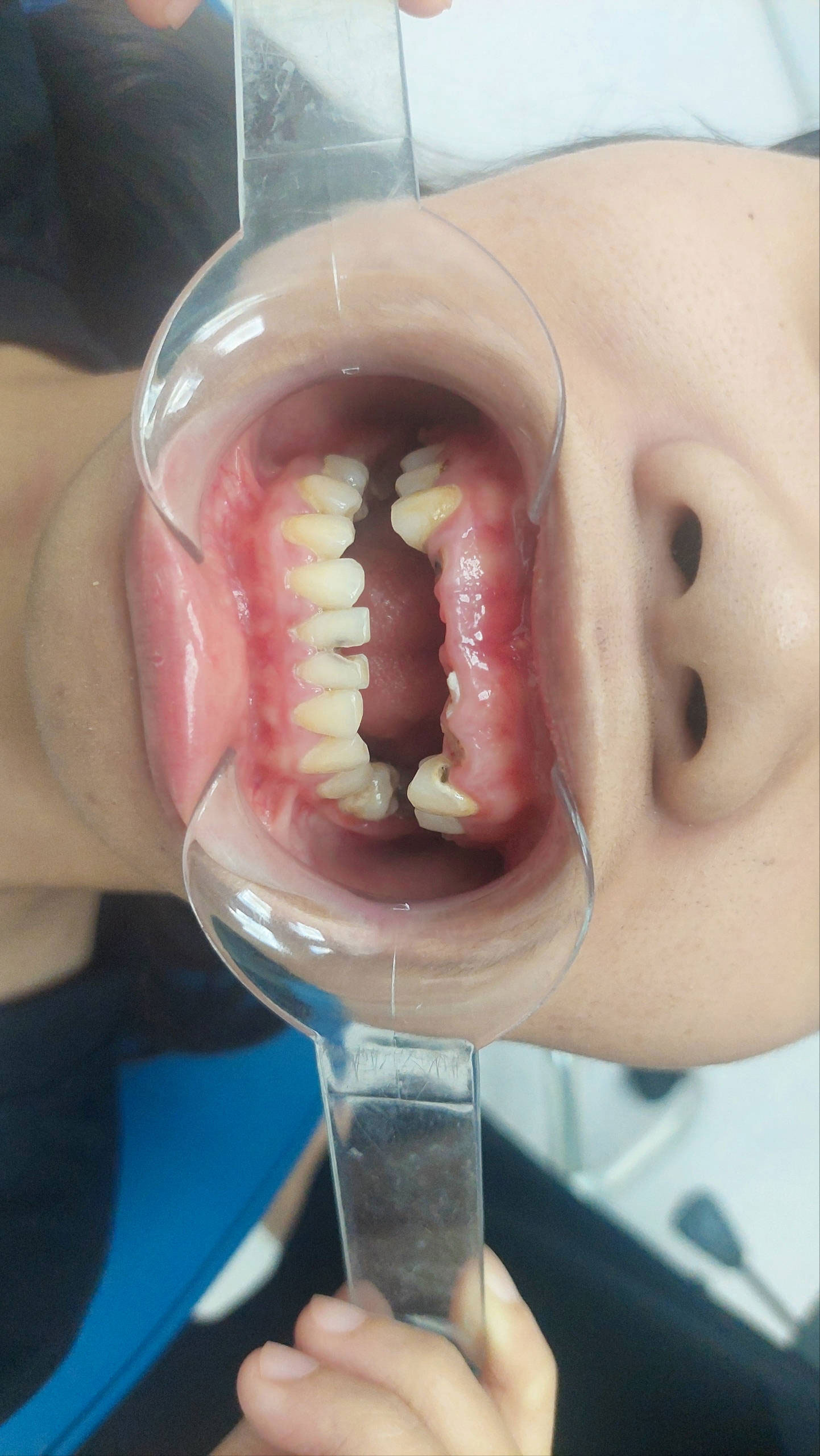 Client before procedure, front view