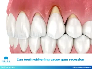 Can teeth whitening cause gum recession? Important notes