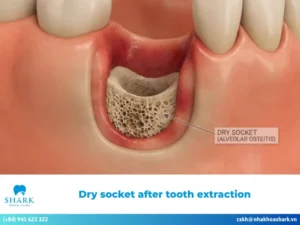 What causes dry socket after tooth extraction? Prevention tips