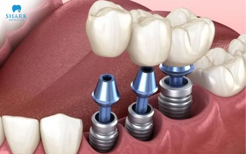 Post-treatment care instructions after dental implant placement