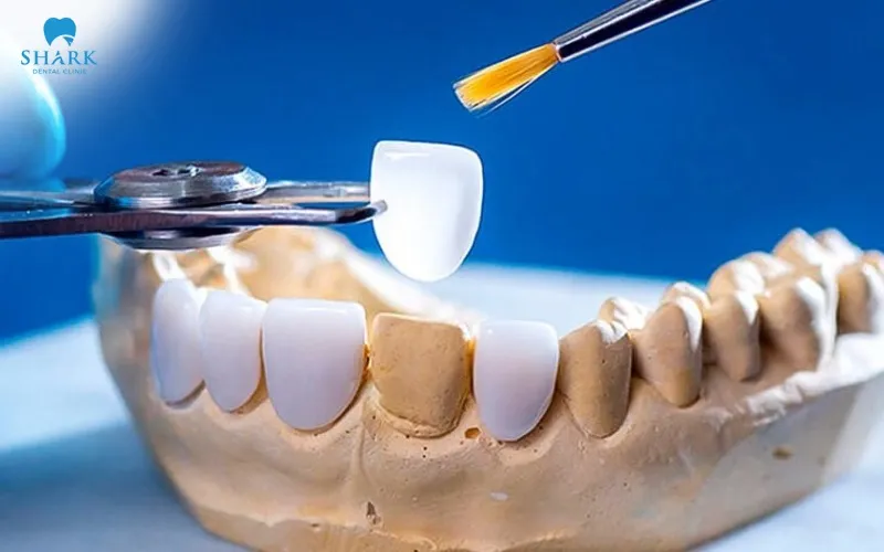Post-treatment care instructions after dental crowns and porcelain veneers