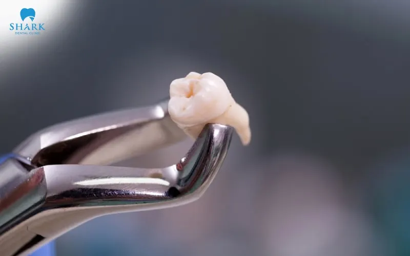 Post-treatment care instructions after tooth extraction and wisdom tooth removal