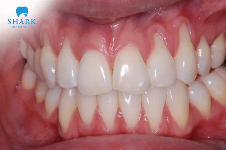 Gum recession can occur for many different reasons, including improper oral hygiene habits, genetic factors, or hormonal changes within the body