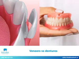 Veneers vs dentures: Which option should you choose?