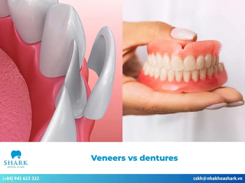 Veneers vs dentures: Which option should you choose?