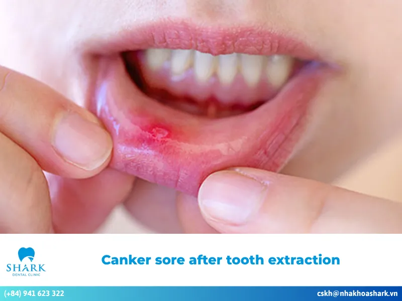 Canker sore after tooth extraction – Effective treatment solutions