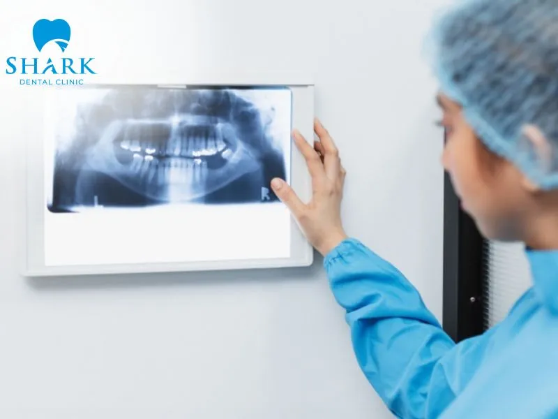 Traditional dental X-rays are commonly used to quickly evaluate the position, shape, and development of wisdom teeth