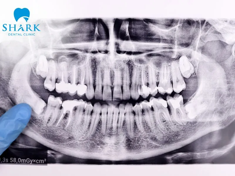 Pregnant women, children, and individuals with certain medical conditions, such as cellulitis, should consult their dentist or healthcare provider before undergoing a wisdom teeth X-ray