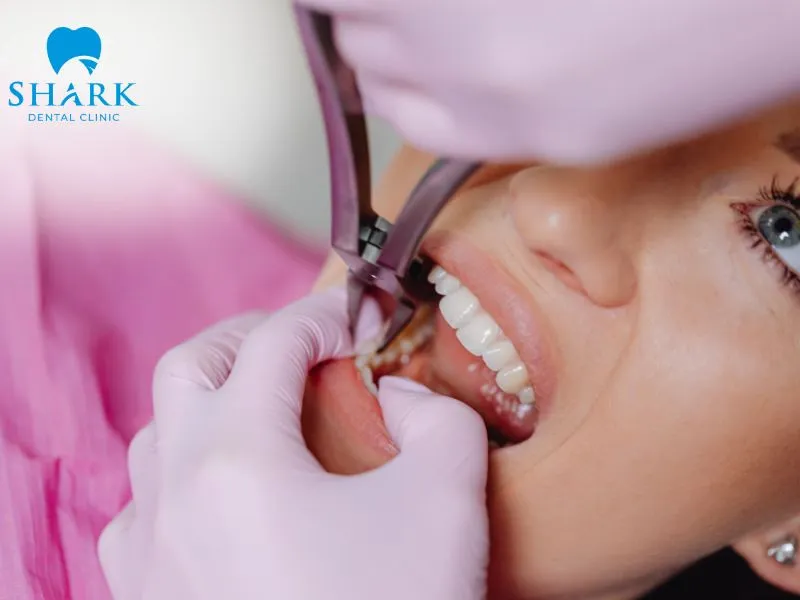 Wisdom tooth extraction is an effective solution for this condition, but it should only be performed under the guidance of a dental professional