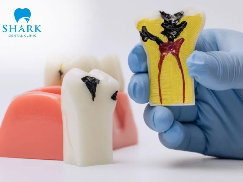 Infection at the extraction site is one of the common causes of small openings or persistent holes that may develop after wisdom tooth removal