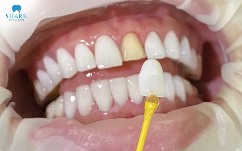 Removable veneers help cover imperfections such as tooth discoloration, gaps between teeth, or uneven teeth, thereby effectively improving overall smile aesthetics