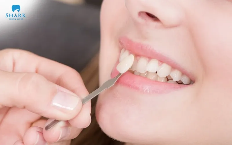 The cost of removable veneers is not fixed and may vary depending on multiple factors such as material type, design quality, and the dental clinic chosen