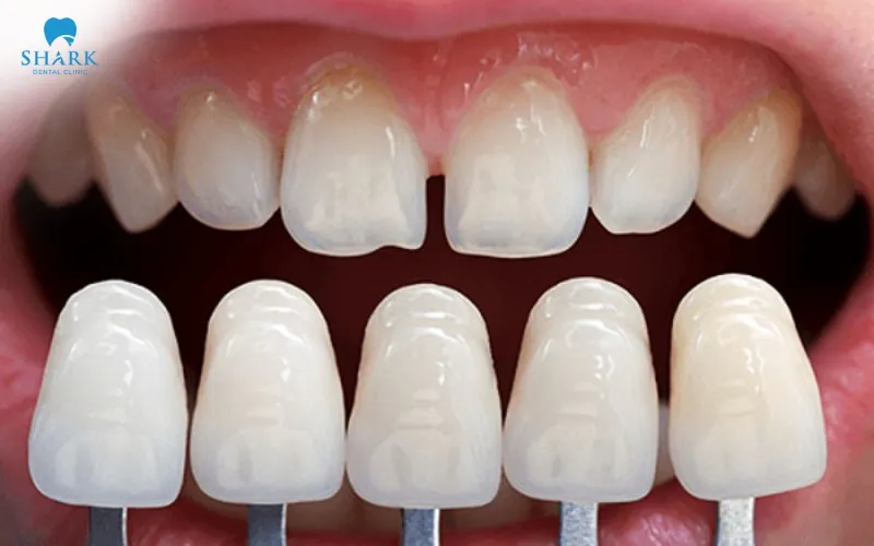 The material used for veneers is one of the most important factors affecting the durability and lifespan of this cosmetic dental method