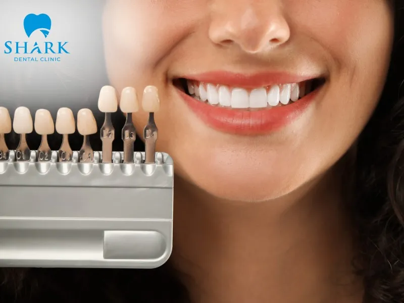 Veneers are ultra-thin, usually around 0.3–0.5 mm thick, helping effectively conceal imperfections such as tooth discoloration, staining, and yellowing