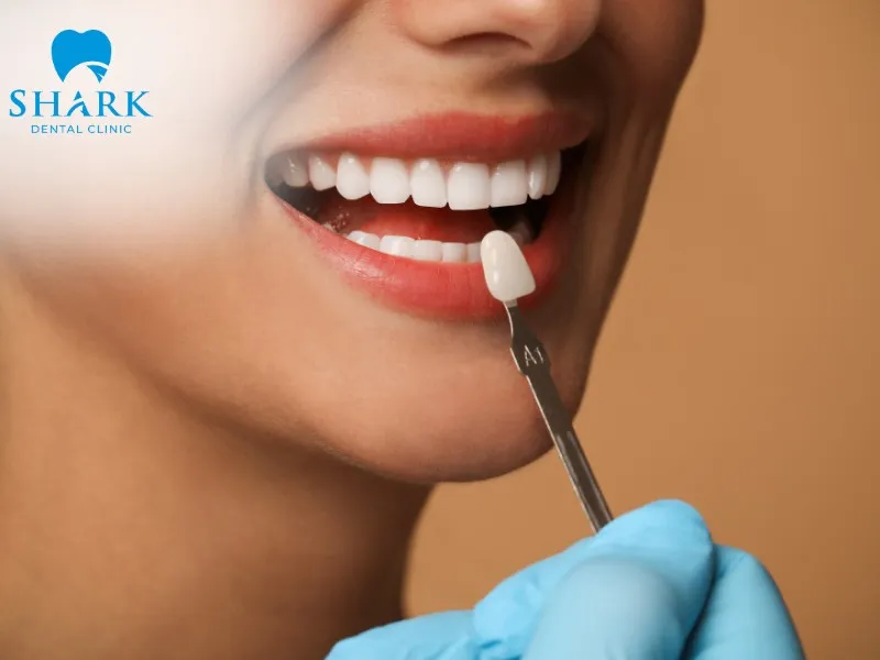 Veneers provide high aesthetic value while helping preserve the natural tooth structure