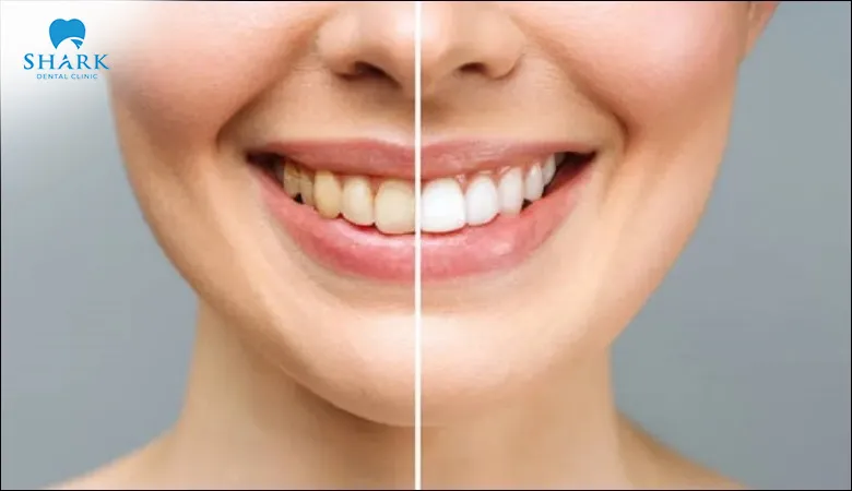 Following your dentist’s recommendations for oral care and maintenance can help preserve the effects of teeth whitening treatments for longer