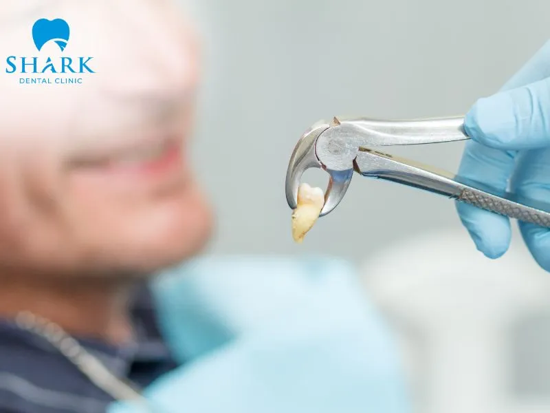Wisdom teeth are often recommended for extraction if they are severely impacted, significantly misaligned, or associated with a high risk of infection