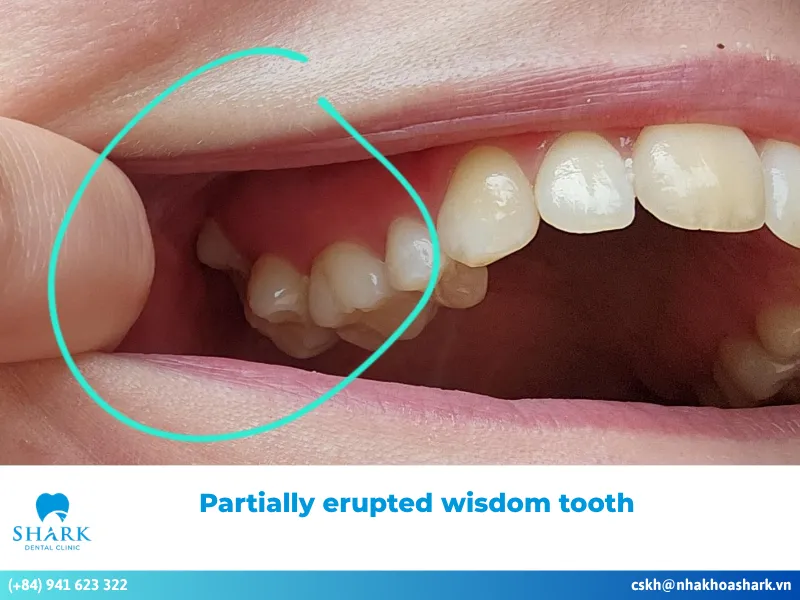 What is a partially erupted wisdom tooth, and is it dangerous?