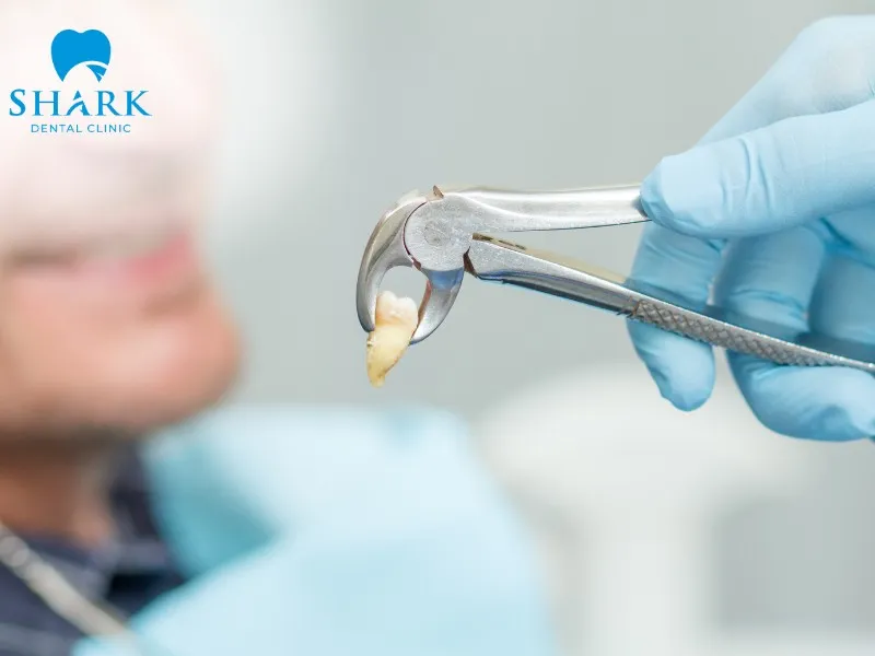 Around 14 days after the extraction procedure, the wound site is usually fully closed