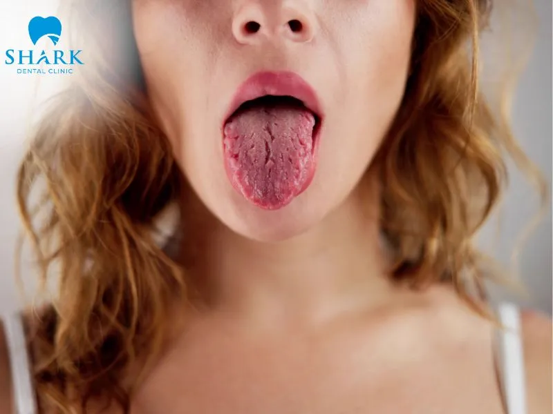 One of the common causes of a cavity in the front tooth is dry mouth