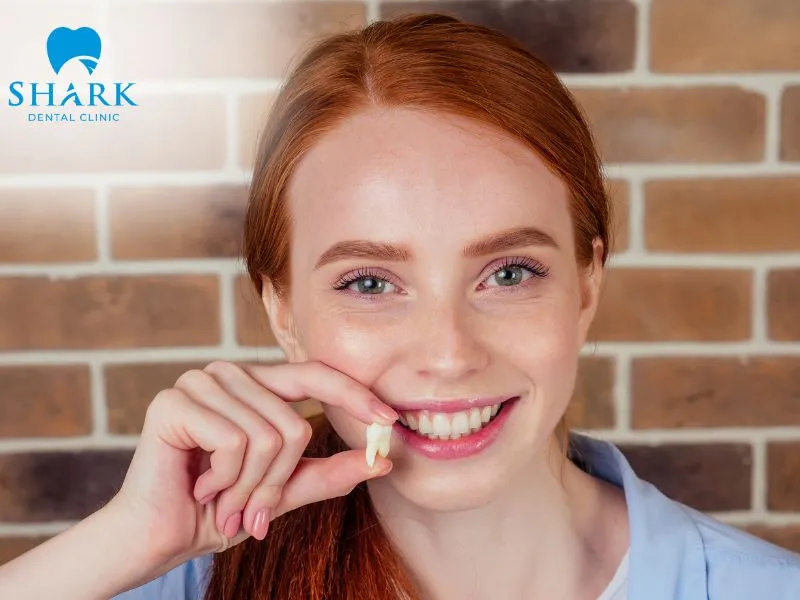 A partially impacted wisdom tooth is a condition in which only part of the tooth emerges through the gum, while a portion of the crown remains covered beneath the gum tissue