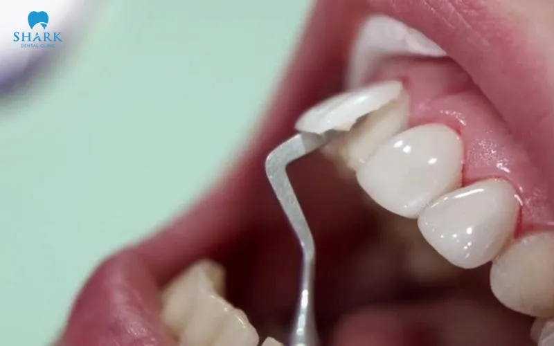 Veneers can technically be removed without immediate replacement; however, this option is rarely recommended by dentists as it may affect tooth protection and aesthetics