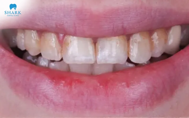 The natural whiteness and surface gloss of the teeth may be reduced after the veneers are removed