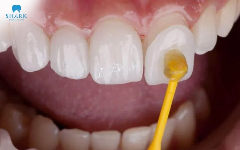 You may feel slight discomfort during the veneer removal process, but it is generally not painful