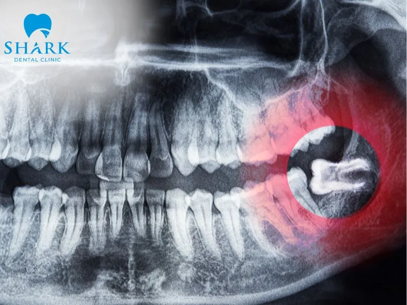 Wisdom teeth are typically larger and have more grooves and crevices than other teeth, making them more susceptible to bacterial buildup, infection, and tooth decay