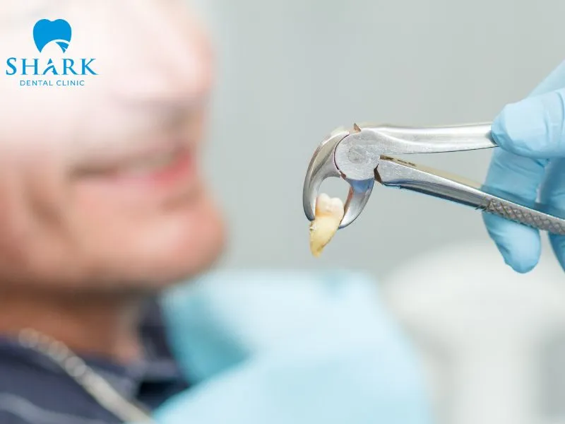 A severely decayed tooth often requires extraction when the damage is extensive and the tooth can no longer be restored effectively
