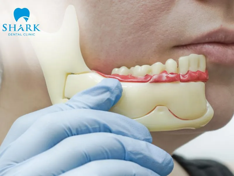 A wisdom tooth cavity that persists for an extended period can cause chronic damage and may increase the risk of developing dangerous jawbone cysts