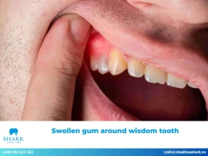Swollen gum around wisdom tooth: Causes and treatment
