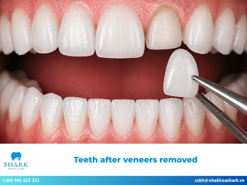 Teeth after veneers removed: Are they ruined or sensitive?