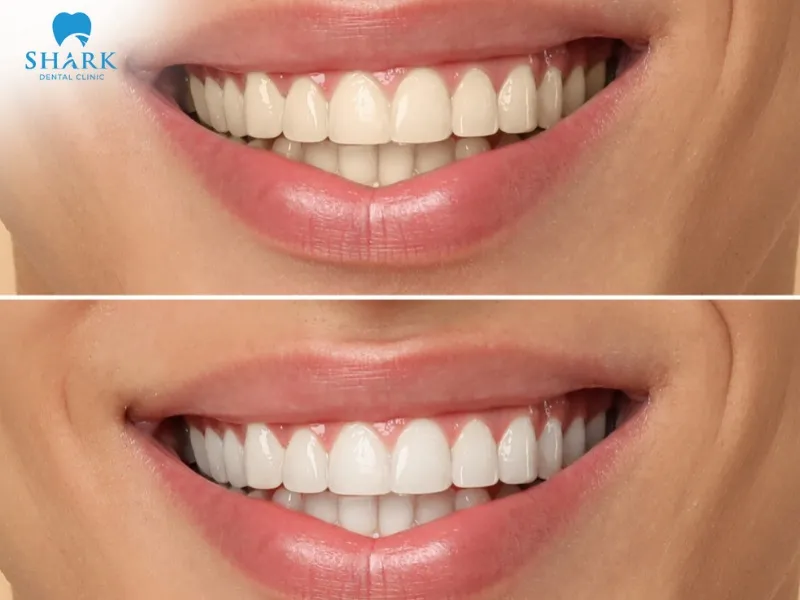 Dark-colored foods and beverages may cause surface stains