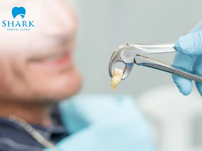 A tooth extraction bone graft procedure helps ensure sufficient jawbone conditions for Implant treatment while minimizing the risk of jawbone resorption