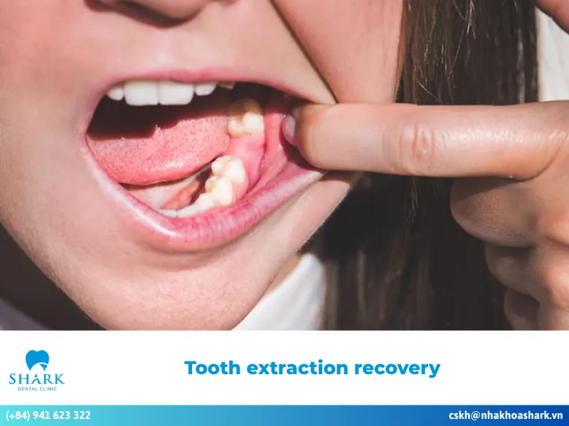 How long does tooth extraction recovery take? Healing process