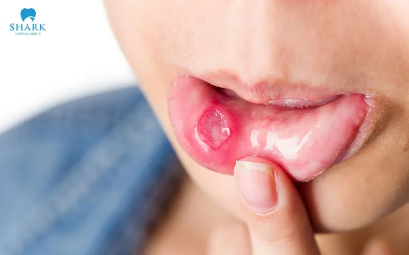 Mouth ulcers are a condition caused by injury or irritation to the soft tissues, leading to the formation of sores inside the oral cavity