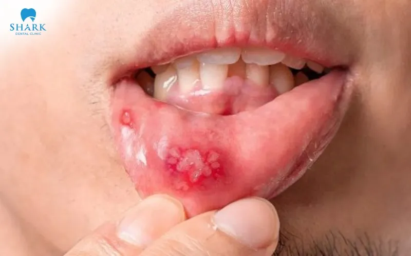 In some cases, the ulcer may become larger and extend deeper into the tissue, causing more intense pain and a longer healing period