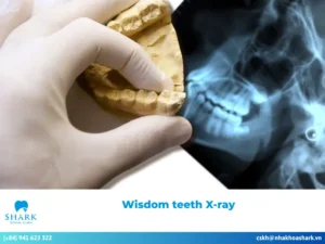 Is a wisdom teeth X-ray necessary? What types are available?